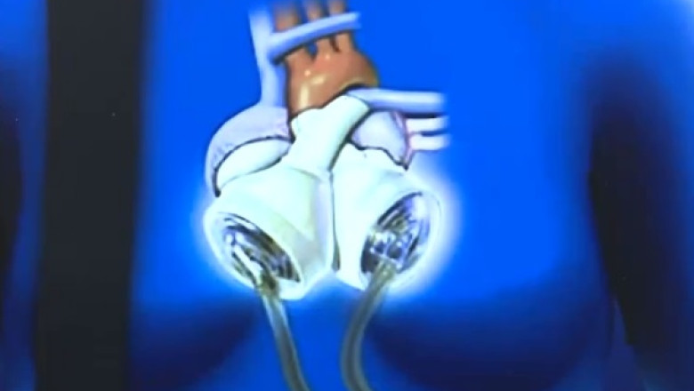 Studentii de la Iasi lucreaza la realizarea unei inimi artificiale din titan. Proiectul va fi prezentat in SUA Imagine