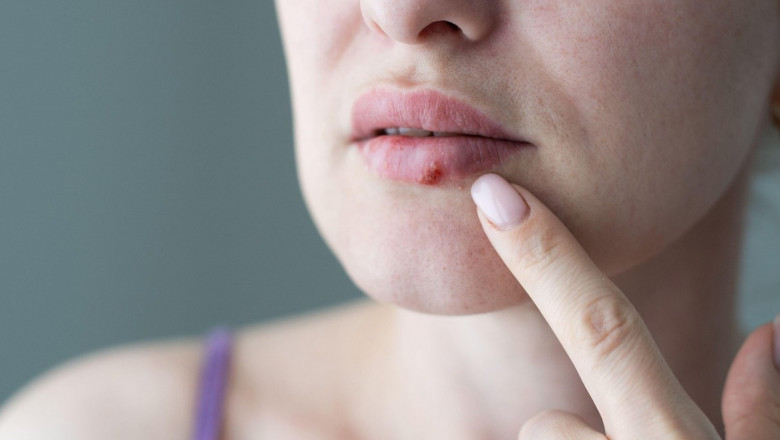 STUDIU. Cum a aparut virusul care provoaca herpesul facial. Ar putea avea o vechime „surprinzatoare” de doar 5.000 de ani Imagine