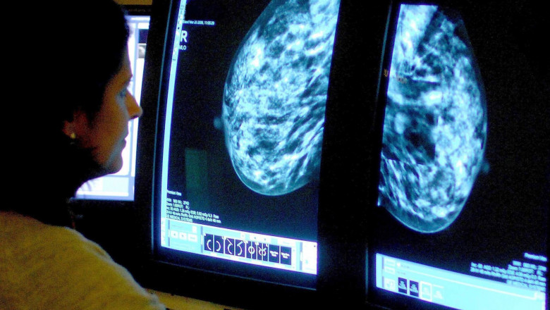 STUDIU Expertii au stabilit care este principala cauza a cancerului la nivel mondial. A provocat peste 30% din cazuri Imagine