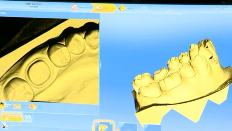 Tehnologie 3D pentru un zambet perfect. Un robot dentar realizeaza fatete si coroane in timp record Imagine