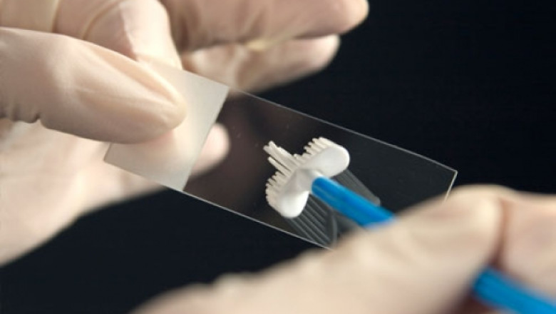 Testul Papanicolau, gratuit  Imagine