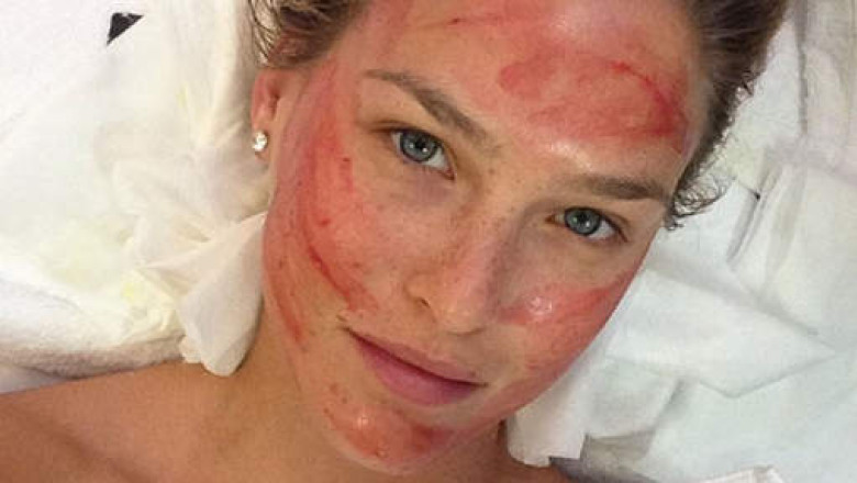 Top modelul Bar Refaeli recurge la procedura „vampire facelift” Imagine