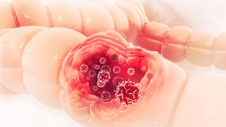 Tratamentul modern al cancerului colorectal, cea mai frecventa afectiune oncologica diagnosticata in Romania Imagine