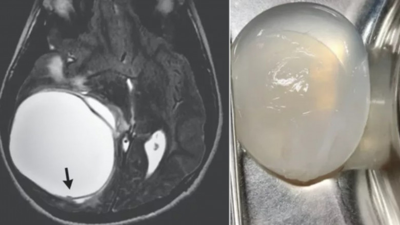 Un baiat de 14 ani care acuza dureri de cap si stari de voma avea o tumoare uriasa la creier provocata de viermii intestinali Imagine