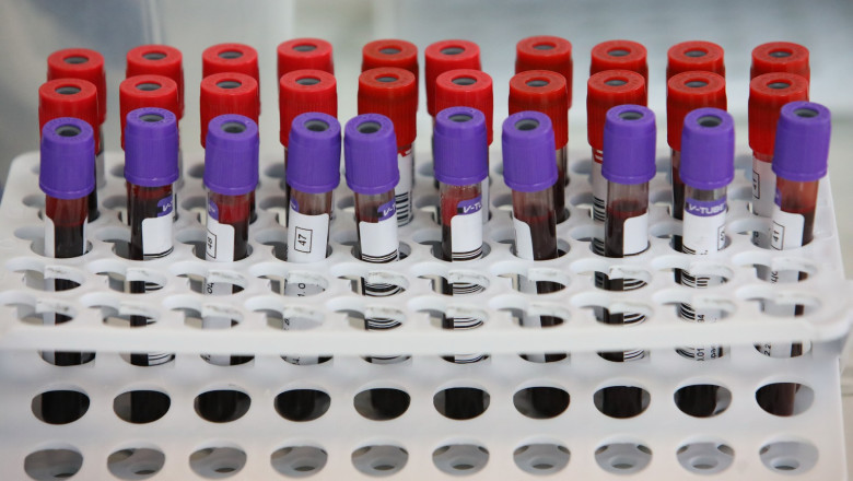 Un barbat din Iasi a fost diagnosticat cu malarie. Medic: A venit la spital la timp, complicatiile bolii pot fi grave Imagine