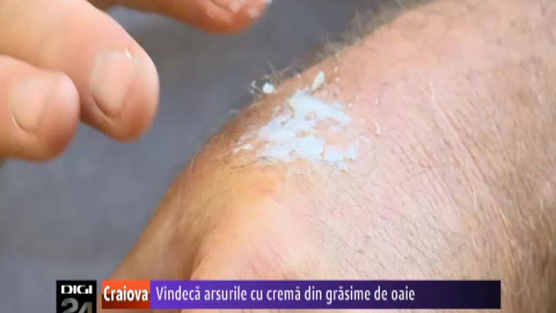 Un doljean a inventat o crema pentru vindecarea arsurilor. Inventatorul si-a brevetat produsul Imagine