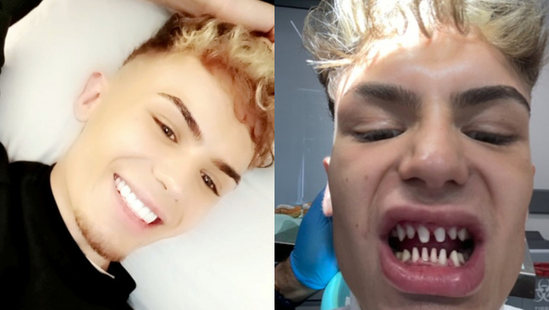 Un tanar de 22 de ani se plange ca arata „ca un rechin” dupa ce s-a dus la dentist, in Turcia Imagine