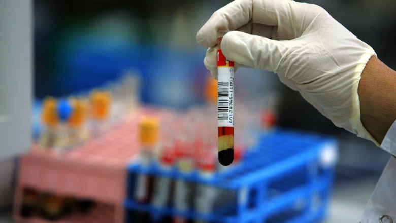 Un test de sange pentru diagnosticarea bolii Alzheimer, autorizat in Japonia Imagine