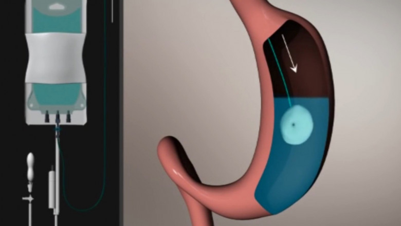 Un tip de balon gastric, considerat prea riscant, a fost retras de pe piata din Franta Imagine