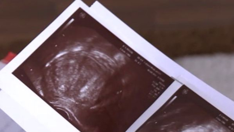 Una din trei femei din Romania sufera de fibrom uterin Imagine