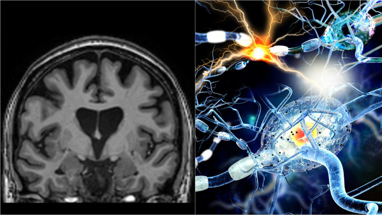 Una dintre cele mai devastatoare boli ereditare a fost tratata cu succes pentru prima data folosind o tehnica genetica ingenioasa Imagine