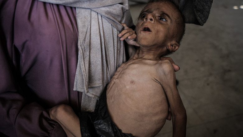 Unicef: peste 7.000 de copii, cu varste sub 5 ani, din Gaza au fost inclusi in programe de recuperare din cauza malnutritiei acute Imagine