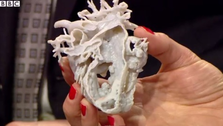 Viata unei fetite de doi ani, salvata de tehnologia 3D Imagine