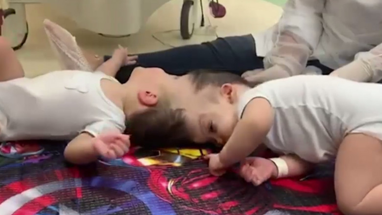 VIDEO. Siamezi care erau uniti in zona capului, despartiti cu succes dupa o operatie de 27 de ore Imagine
